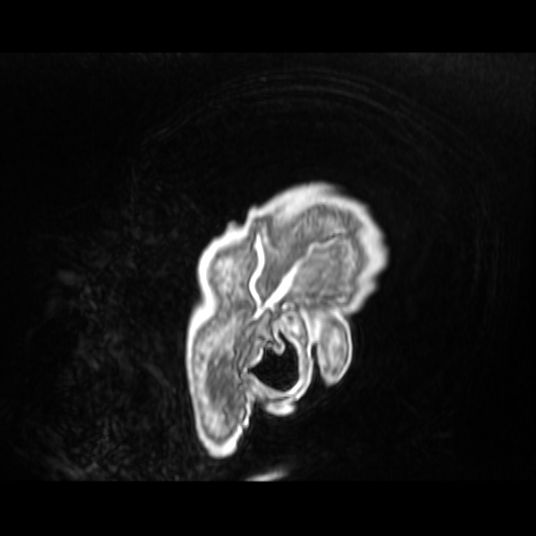 Cerebellar metastasis of pulmonary adenocarcinoma, cavernous venous malformation, and developmental venous anomaly (Radiopaedia 85827-101661 Sagittal T1 C+ 89).jpg