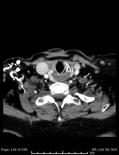 File:Cerebellar strokes due to intracranial giant cell arteritis (Radiopaedia 68799-78510 CT angiogram 126).jpg