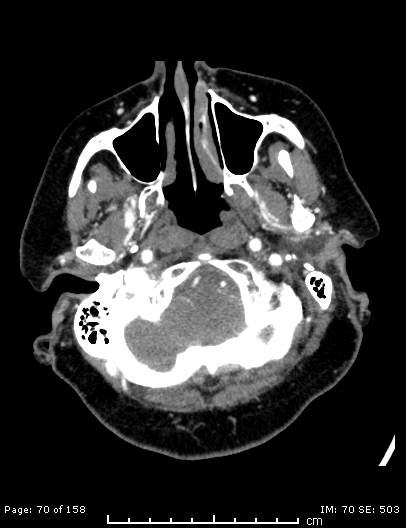 Cerebellar strokes due to intracranial giant cell arteritis (Radiopaedia 68799-78510 CT angiogram 70).jpg