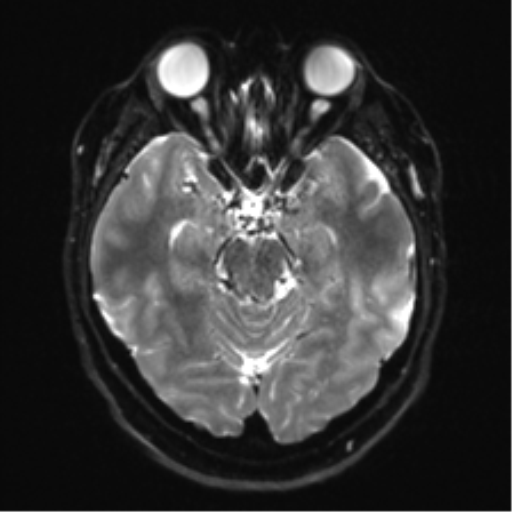 Cerebellopontine angle meningioma (Radiopaedia 48434-53348 Axial DWI 14).png