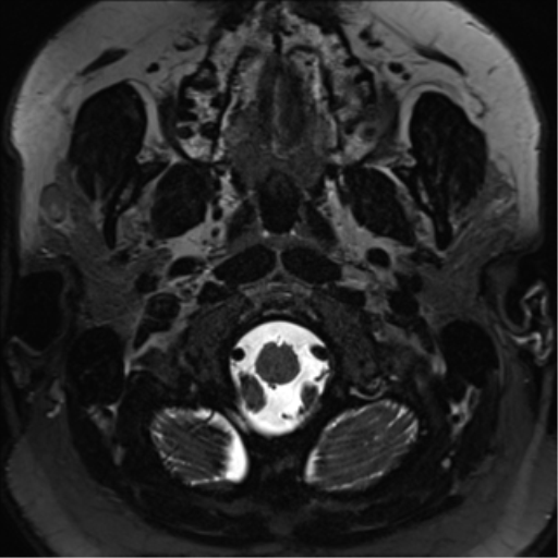 Cerebellopontine angle meningioma (Radiopaedia 48434-53348 Axial T2 Space 1).png