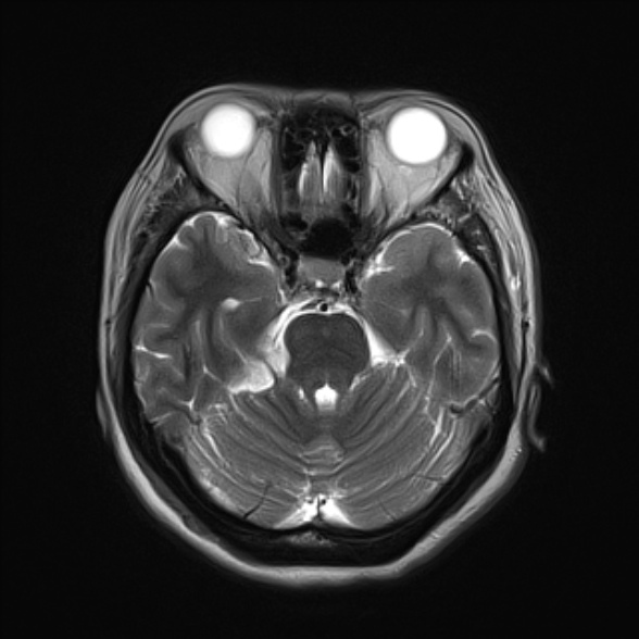 File:Cerebellopontine angle meningioma (Radiopaedia 53561-59591 Axial T2 9).jpg
