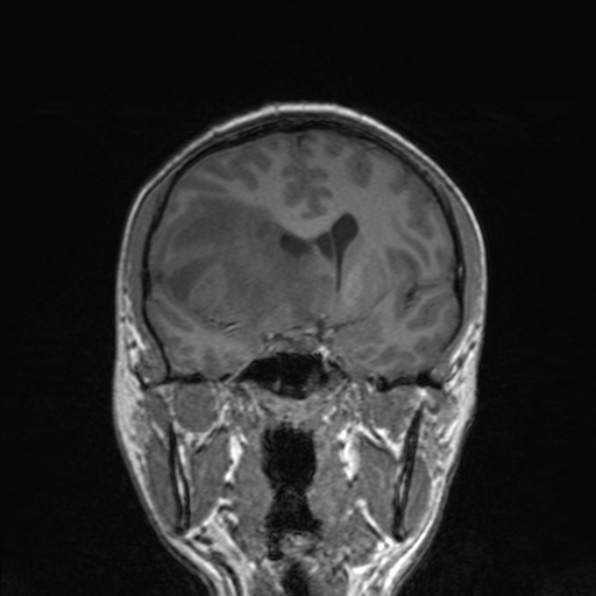 Cerebral abscess (Radiopaedia 24212-24478 Coronal T1 95).jpg