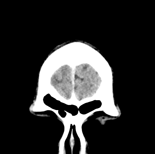 Cerebral abscess (Radiopaedia 60342-68008 Coronal non-contrast 5).png