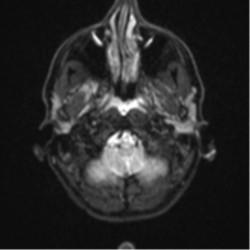 Cerebral abscess (Radiopaedia 60342-68009 Axial DWI 3).png