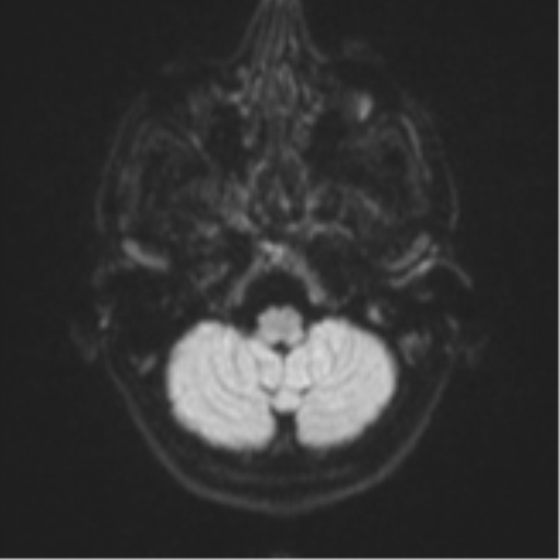 Cerebral abscess (Radiopaedia 60342-68009 Axial DWI 41).png