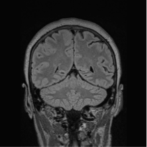 Cerebral abscess from pulmonary arteriovenous malformation (Radiopaedia 86275-102291 Coronal FLAIR 30).png