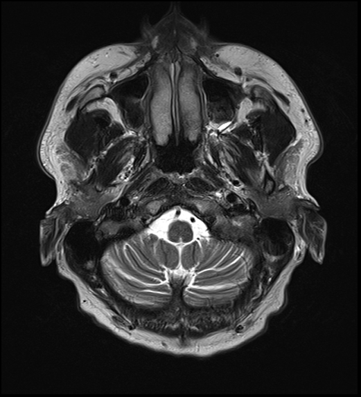 File:Cerebral abscess with ventriculitis (Radiopaedia 78965-91878 Axial T2 6).jpg