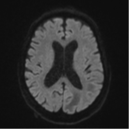 Cerebral abscesses- medically managed (Radiopaedia 45183-49179 Axial DWI 45).png