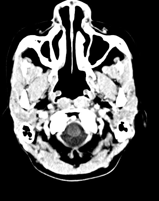 Cerebral abscesses (Radiopaedia 70458-80568 Axial Contrast 10).jpg