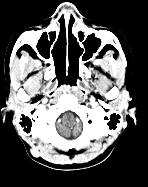 Cerebral abscesses (Radiopaedia 70458-80568 Axial Contrast 12).jpg