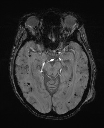 File:Cerebral amyloid angiopathy-related inflammation (Radiopaedia 74836-85849 Axial SWI 29).jpg
