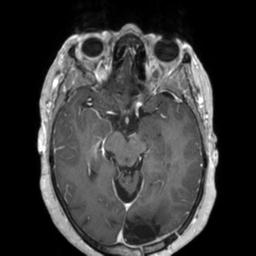 Cerebral amyloid angiopathy (Radiopaedia 29129-29518 Axial T1 C+ 63).jpg