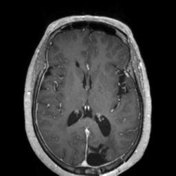 Cerebral amyloid angiopathy (Radiopaedia 29129-29518 Axial T1 C+ 81).jpg