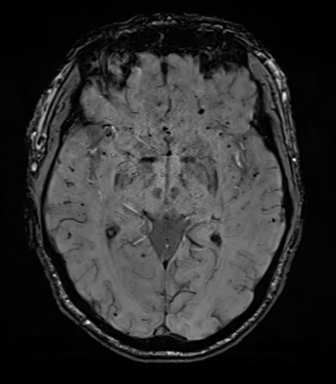 File:Cerebral amyloid angiopathy (Radiopaedia 46082-50433 Axial SWI 38).png