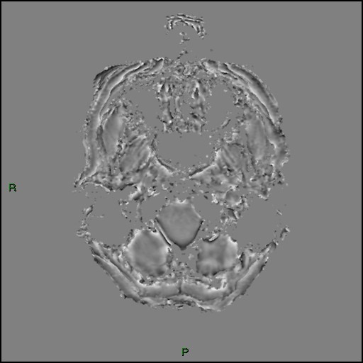 Cerebral amyloid angiopathy (Radiopaedia 77506-89664 H 12).jpg
