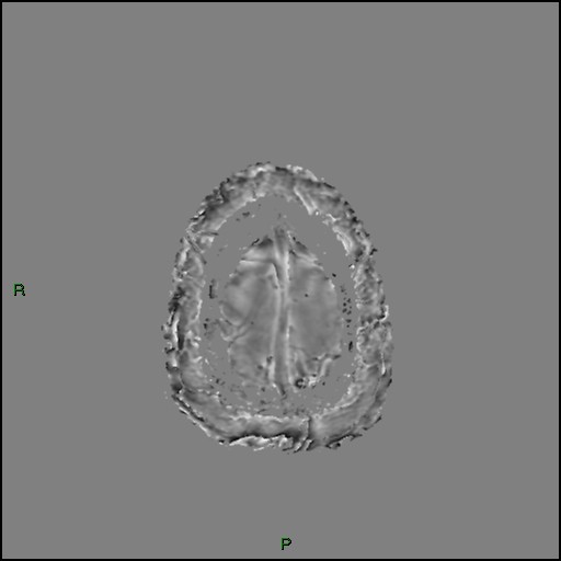 Cerebral amyloid angiopathy (Radiopaedia 77506-89664 H 96).jpg