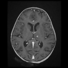 Cerebral and spinal tuberculosis (Radiopaedia 90489-107837 Axial T1 C+ 111).jpg
