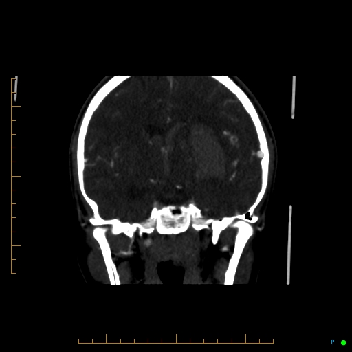 Cerebral arteriovenous malformation (AVM) (Radiopaedia 78162-90706 Coronal CTA 55).jpg