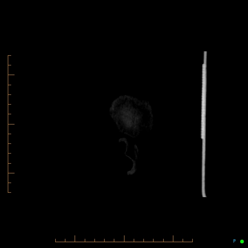File:Cerebral arteriovenous malformation (AVM) (Radiopaedia 78162-90706 Sagittal CTA 4).jpg