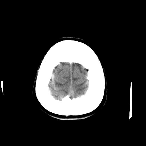 Cerebral arteriovenous malformation (Radiopaedia 28518-28759 Axial non-contrast 67).jpg