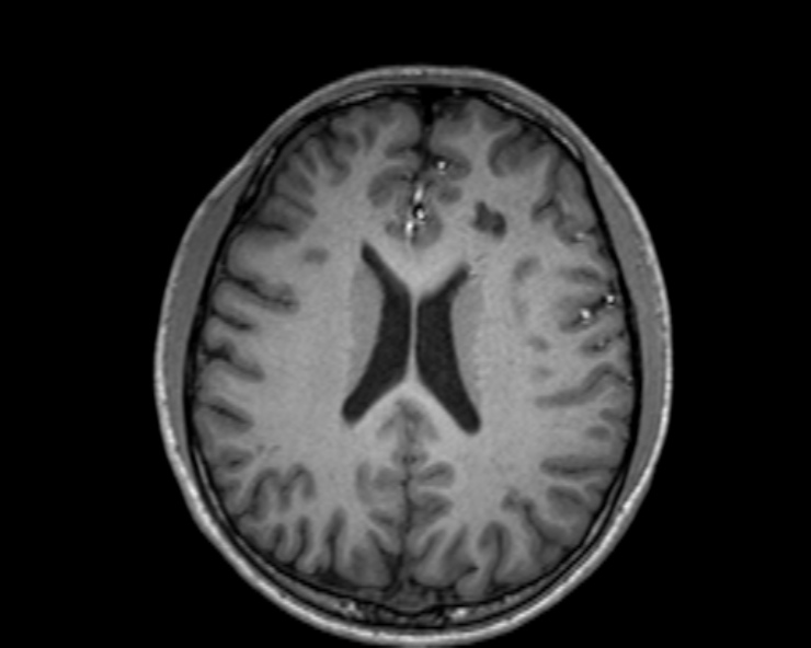 Cerebral arteriovenous malformation (Radiopaedia 30198-30813 Axial T1 28).jpg