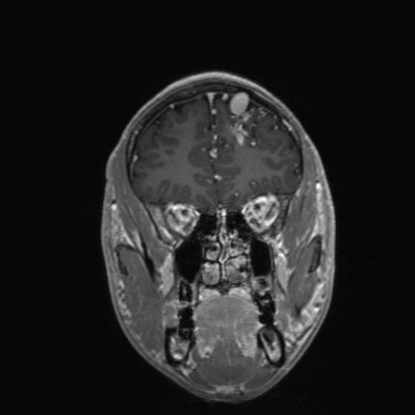 Cerebral arteriovenous malformation (Radiopaedia 30198-30813 F 17).jpg