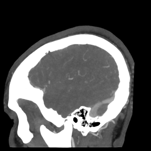 Cerebral arteriovenous malformation (Radiopaedia 39259-41505 Sagittal 51).png