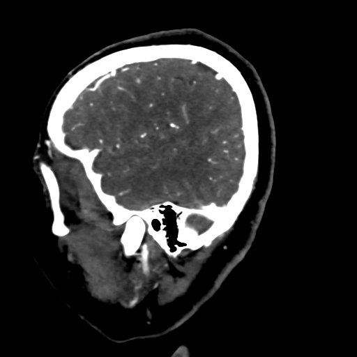 File:Cerebral arteriovenous malformation (Radiopaedia 73830-84645 Sagittal C+ delayed 16).jpg