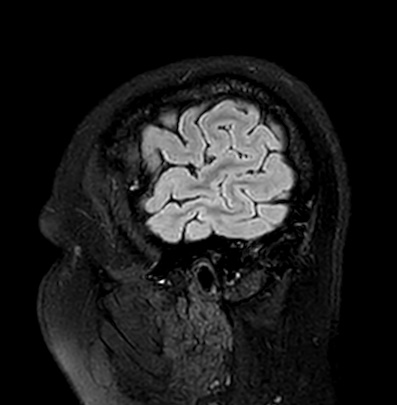 Cerebral arteriovenous malformation (Radiopaedia 74411-85746 Sagittal FLAIR 8).jpg