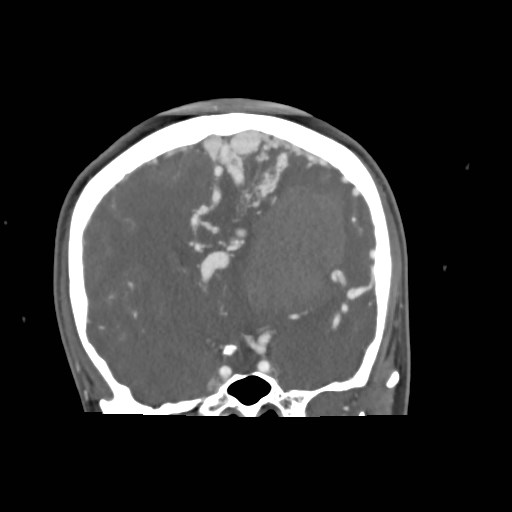 File:Cerebral arteriovenous malformation (Radiopaedia 79677-92888 B 16).jpg