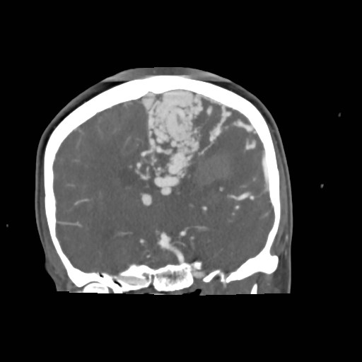File:Cerebral arteriovenous malformation (Radiopaedia 79677-92888 B 19).jpg
