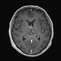 Cerebral arteriovenous malformation (Radiopaedia 84015-99245 Axial T1 C+ 85).jpg