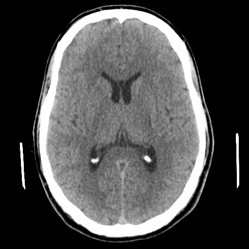File:Cerebral arteriovenous malformation (Spetzler-Martin grade 2) (Radiopaedia 41262-44076 Axial non-contrast 30).png
