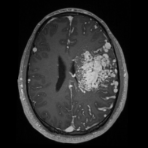 Cerebral arteriovenous malformation - huge (Radiopaedia 35734-37272 Axial T1 C+ 46).png