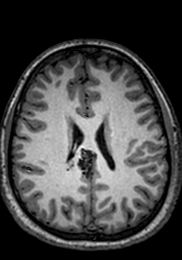 Cerebral arteriovenous malformation at posterior body of corpus callosum (Radiopaedia 74111-84925 Axial T1 103).jpg