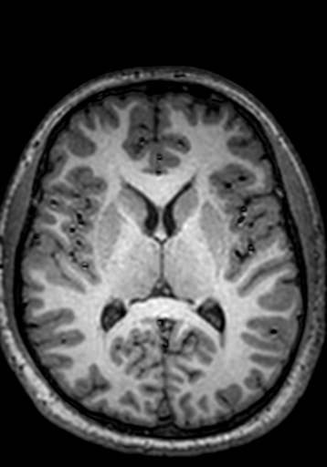 Cerebral arteriovenous malformation at posterior body of corpus callosum (Radiopaedia 74111-84925 Axial T1 136).jpg