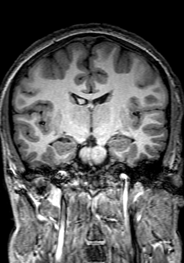 File:Cerebral arteriovenous malformation at posterior body of corpus callosum (Radiopaedia 74111-84925 Coronal T1 164).jpg