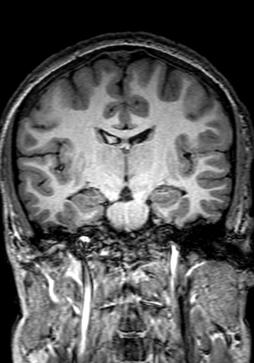 Cerebral arteriovenous malformation at posterior body of corpus callosum (Radiopaedia 74111-84925 Coronal T1 167).jpg