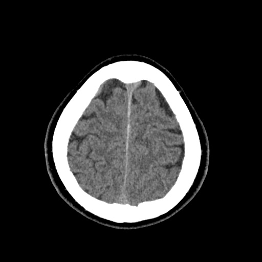Cerebral arteriovenous malformation with lobar hemorrhage (Radiopaedia 35598-37117 Axial non-contrast 48).jpg