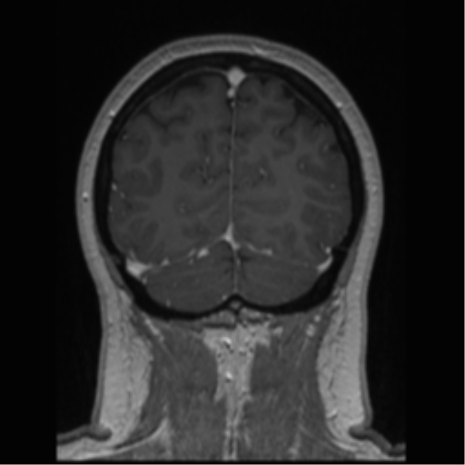 Cerebral cavernoma and development venous anomaly (Radiopaedia 37603-39482 Coronal T1 C+ 20).png