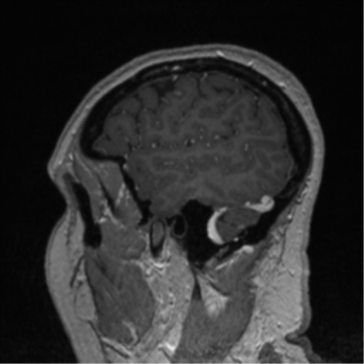 Cerebral cavernoma and development venous anomaly (Radiopaedia 37603-39482 Sagittal T1 C+ 19).png