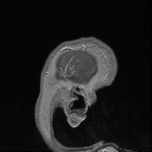 File:Cerebral cavernoma and development venous anomaly (Radiopaedia 37603-39482 Sagittal T1 C+ 7).png