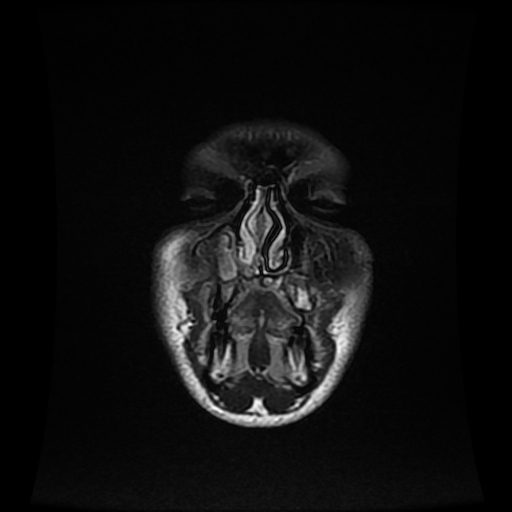 File:Cerebral cavernous venous malformation (Zabramski type II) (Radiopaedia 85511-101198 Coronal FLAIR 1).jpg