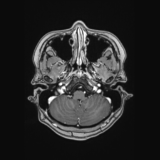 Cerebral cavernous venous malformations (Radiopaedia 48117-52946 Axial T1 C+ 5).png