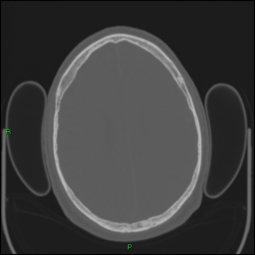 Cerebral contusions (Radiopaedia 33868-35039 Axial bone window 145).jpg