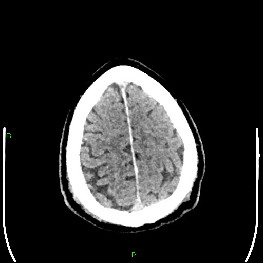 Cerebral contusions (Radiopaedia 33868-35039 Axial non-contrast 186).jpg