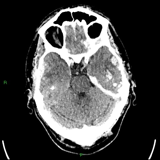File:Cerebral contusions (Radiopaedia 33868-35039 Axial non-contrast 64).jpg