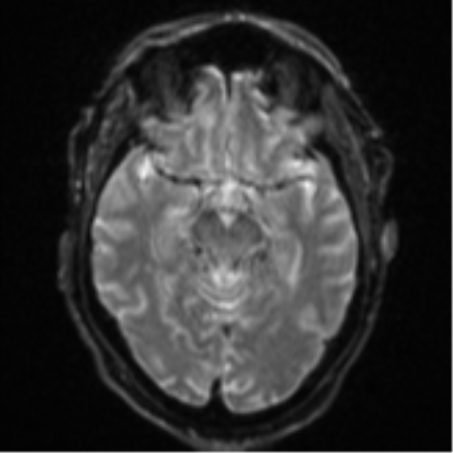 Cerebral embolic infarcts (embolic shower) (Radiopaedia 57395-64342 Axial DWI 15).png