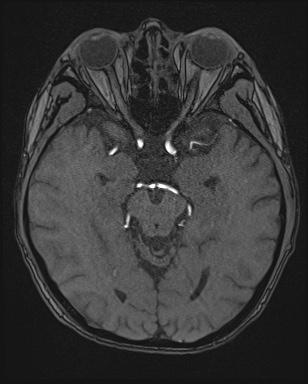 Cerebral embolic infarcts (embolic shower) (Radiopaedia 72391-82921 Axial MRA 62).jpg